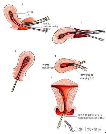 上环的视频,揭秘上环术的神奇魅力
